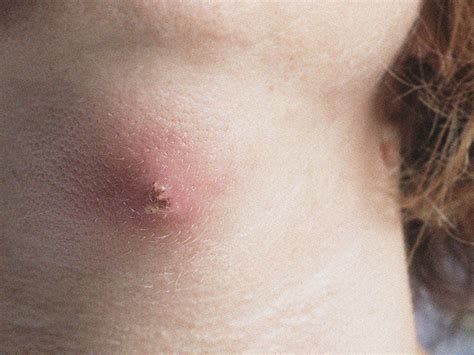 A dentist or hygienist will look for red, swollen. best antibiotic for pseudomonas aeruginosa