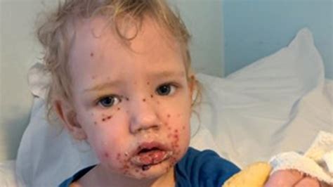 Herpes simplex viruses are amongst the most common infectious agents of man, and either hsv type appears to be capable of infecting similar body sites. Toddler becomes infected with herpes after suspected kiss ...