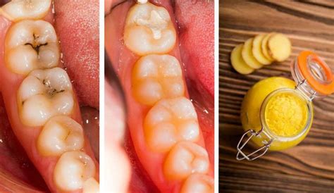 Maybe you would like to learn more about one of these? Reverse Cavities Naturally And Heal Tooth Decay With This ...