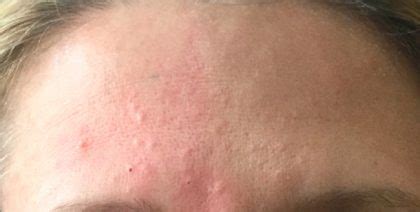 Sebaceous hyperplasia is a fairly common and frustrating skin condition that can be treated effectively using natural methods. Sebaceous Hyperplasia Treatment In NJ | Laser Removal Cost ...