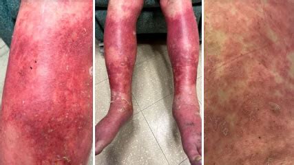 In july, the first one was approved for general use — a vaccine for ebola, also made by johnson & johnson. Skin 'peeled off' in rare reaction to JOHNSON & JOHNSON ...