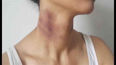 It also helps with bruises, which is what a. how to get rid of a hickey with a coin - get rid of a ...