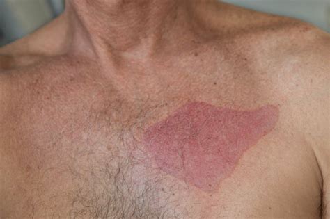 As long as you're not allergic to the ingredients, if you use the right hair removal cream on the right part of your body and follow the instructions carefully, you. How to Treat a Burn From Nair (with Pictures) | eHow