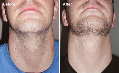 I did laser hair removal because my beard was so thick and coarse that i was having all nature of problems. Men's Hair Removal - LasaDerm