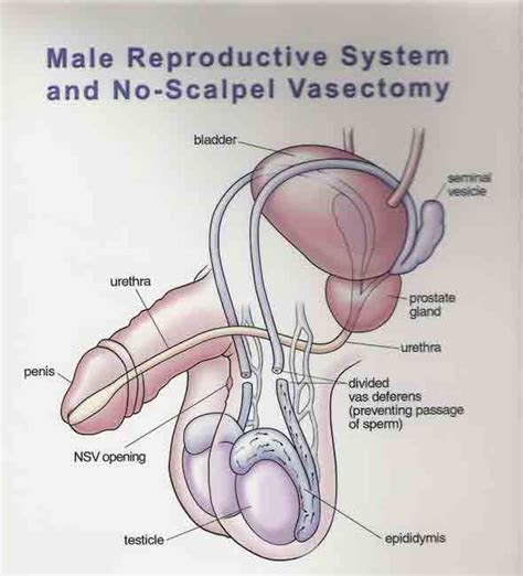 Your healthcare provider will tell you how to prepare for your procedure. 11_Vasectomy_Diagram - No Stork