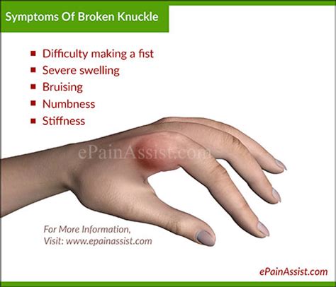 If the break is a simple fracture, in which the parts of your bone are still lined up properly, your doctor will probably put you in a walking boot for about three taping a suspected broken toe can help alleviate pain if the break is simple and the bones are aligned. Broken Knuckle or Fractured Knuckle: Treatment and Symptoms