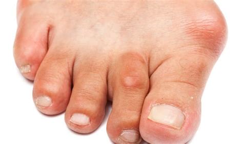 Those with a family history of bunions tend to pass it along down each generation. Bunions: Best shoes to prevent the painful foot condition ...