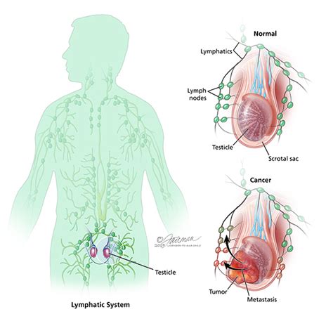 Pain in your neck and throat. What are the Stages of Testicular Cancer? - Urology Care ...