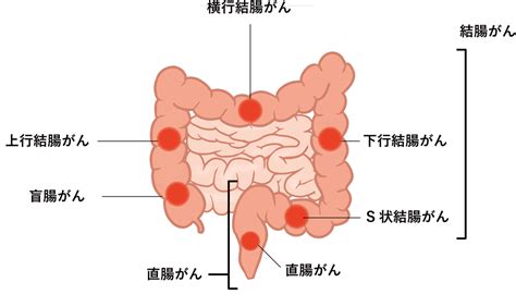 #双極性障害 男性→男性 #性被害 #大腸がんⅲ（上行結腸）手術後 #肺がん 転移 ⅳに 再手術後化学療法 現在検査で腫瘍マーカーct共に良好経過観測中 90代父.ひかり双極性 大腸がん（経過観察中）. 大腸がんについて ｜ 富山西総合病院｜富山西 ...