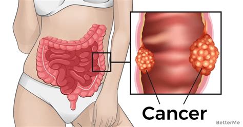 Other signs and symptoms include: 7 early-warning signs of rectal-cancer no one want to talk ...