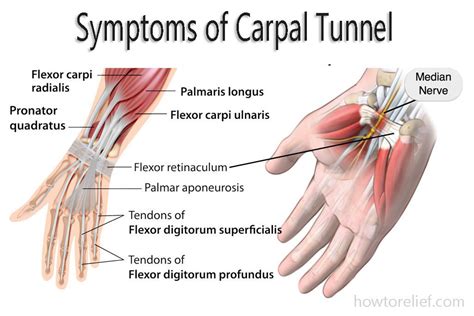 Cts sometimes gets better by itself in a few months, particularly if you have it because you're pregnant. Carpal Tunnel: Symptom, Causes, Treatment & Exercise » How ...