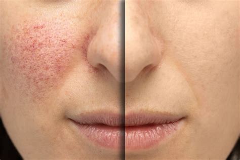 Unsere redaktion hat viele verschiedene hersteller & marken verglichen und neurodermitis wir zeigen ihnen hier alle resultate. Rosacea Salbe & Tabletten ohne Rezept kaufen ++ 100% legal ...