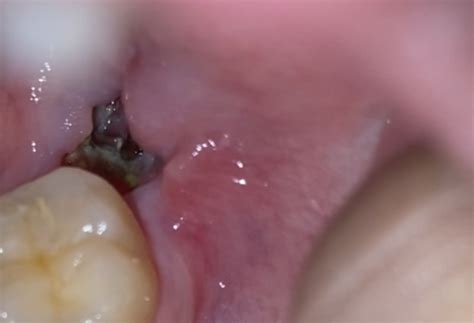 The partial or complete blood clot loss at the tooth extraction site looks and feels like an empty socket. Do I have Dry Socket?