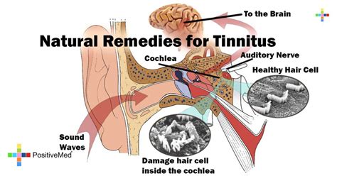 Tinnitus can be caused by many health conditions. Natural Remedies for Tinnitus