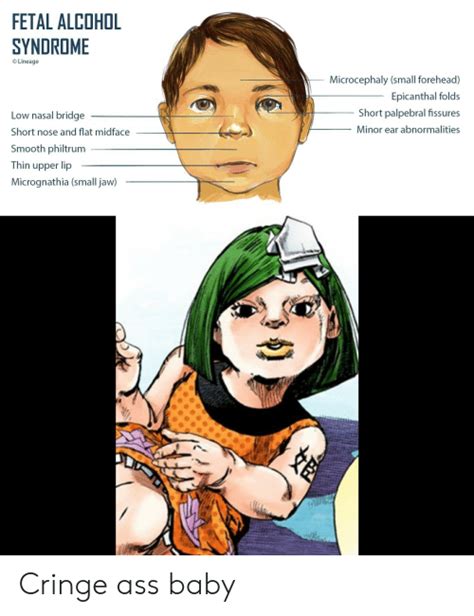 Fold of the eyelid at the inner edge (epicanthic fold) crossed eyes (strabismus) upward slanting of the space between the eyelids (upslanting palpebral fissures) eye misalignment in which one or both of the eyes turn outward (exotropia) visual impairment or blindness as a result of the above ocular symptoms; ️ 25+ Best Memes About Midface | Midface Memes