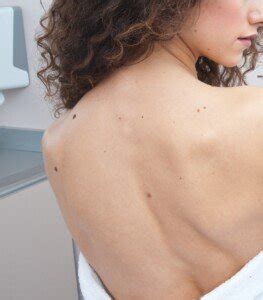 Postmenopausal bleeding is a common symptom of endometrial cancer. SKIN MOLES: Changing, Itching, Bleeding, Size, Color ...