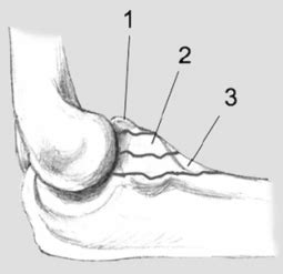 In diesem artikel sollen sowohl diagnostik als auch klassifikation der radiuskopffraktur, behandlungsalgorithmen und techniken der rekonstruktion in abhängigkeit der frakturmorphologie. Diagnostik und Therapie der akuten und chronischen ...