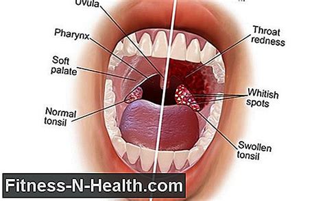 Sometimes only one lymph node will swell, causing a sore throat on one side. Swollen Lymph Nodes In Stomach Cancer - CancerWalls
