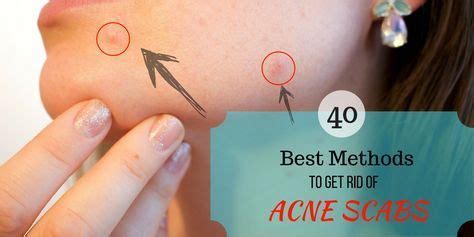 Most respond by using extreme and unnecessary skin treatments or by layering on makeup to hide breakouts, however that can just make things worse. 40 Best Ways to Get Rid of Acne Scabs Overnight | DIY ...