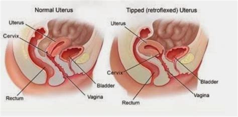 Kram terasa seperti tekanan yang tidak nyaman. Berjaya Hamil Walaupun Rahim Terbalik, Tips untuk Hamil ...