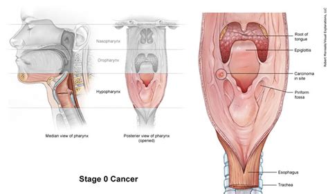 Detecting throat cancer at an early stage is difficult to identify. Throat Cancer Pictures | Med-Health.net