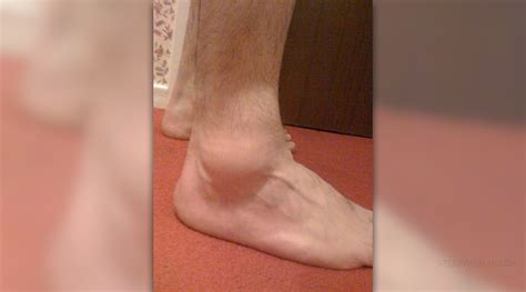 If you've ever experienced unpleasantly plump ankles at the end of a long flight, take heart. What to do for swollen ankles | General center ...