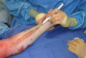 Due to the residual pressure, the incision will often widen substantially. Burn Injuries: When to Treat or Refer - Elite Learning