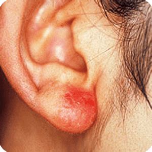 耳・耳たぶがかゆい、腫れる時の原因と対処・治療法｜田辺 ...