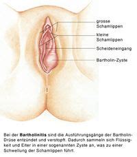 So können die begradigten anteile gut anwachsen. Bartholinitis, Bartholinzyste, Entzündung der ...