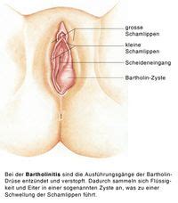 Meanings of schamlippen with other terms in english german dictionary : Bartholinitis, Bartholinzyste, Entzündung der ...