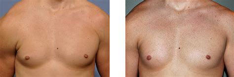 It is characterized by having an underdeveloped or absent chest muscle on one side of. Right Pectoral Implants for Male Poland's syndrome result ...