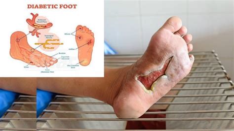 Dengan mengamalkan kayu manis dalam pemakanan, ia akan membantu mengurangkan jumlah glukos dalam darah dan ia sangat berkesan bagi penghidap diabetes. Kaki Hampir Di pot0ng, Kini Kencing Manis Telah Hil4ng ...