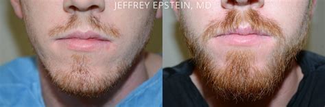Think photoshop, but simplified for everyday users. Facial Hair Photos | Miami, FL | Patient 37051