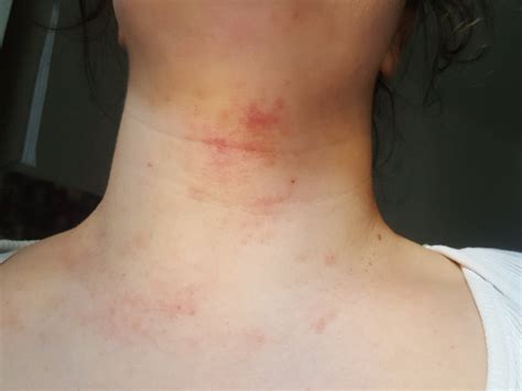 Dermatite atopica ovunque - Dermatite atopica - DermaClub ...