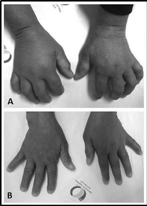 A18.41) is de meest voorkomende vorm van cutane tuberculose bij kinderen. Musculoskeletal Tuberculosis in Dermatomyositis ...