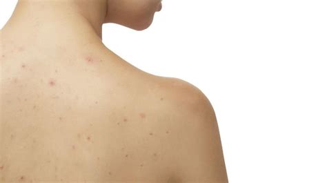 Ruam dapat terjadi karena infeksi pada kulit, infeksi yang menyebar (yang telah menyebar ke seluruh tubuh), reaksi alergi , atau iritasi pada kulit. Bintik Merah pada Kulit Tidak Gatal? Ini 10 Penyebabnya