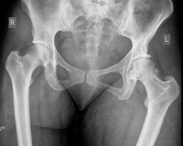 Jeff young is a pro and hero! Recurrent spontaneous hip dislocation in a patient with ...