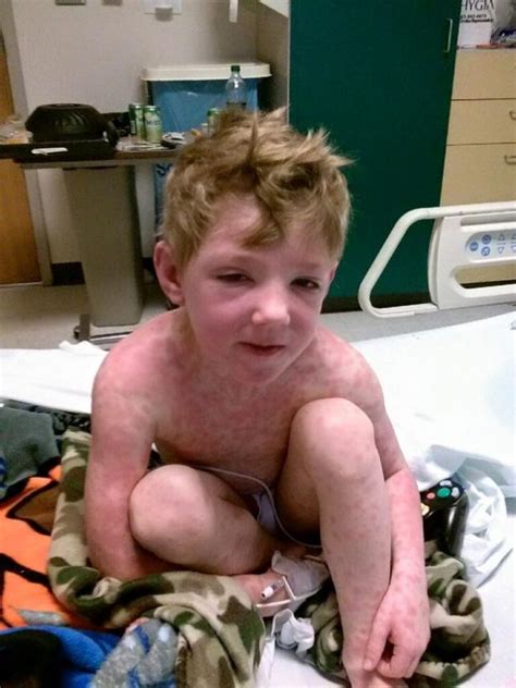 However, the cdc and fda recommend that people who received the j&j vaccine should contact their doctors if they experience any of these symptoms within three weeks of vaccination: Child Complained Of Poison Oak But It Was Stevens Johnson ...