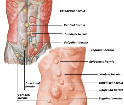 An inguinal hernia is a medical condition where an dr venu gopal pareek has the best team of hernia doctors and hernia surgeons in hyderabad. Puppy Inguinal Hernia Surgery Cost Uk - Carles Pen