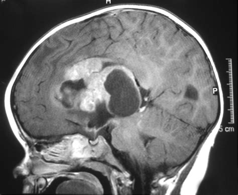 People with a brain tumor may experience the following symptoms or signs. Childhood Brain and Spinal Cord Cancer Tumors - Detection ...