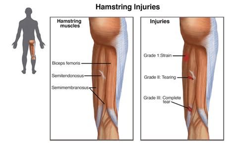Hamstring muscles, pelvic position, and your back pain. Common Muscle Strains of the Hip Joint