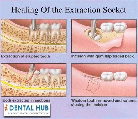 Extraction of the wrong tooth. Unadvised Tooth Extraction Root Canal # ...