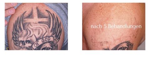 Ob du dein tattoo neu hast, oder es länger hast als dir lieb ist, ein tattoo mit salz zu entfernen, ist ein gefährliches unterfangen. tattooentfernung-tattoo-lasern-rostock-aesthetikzentrum ...