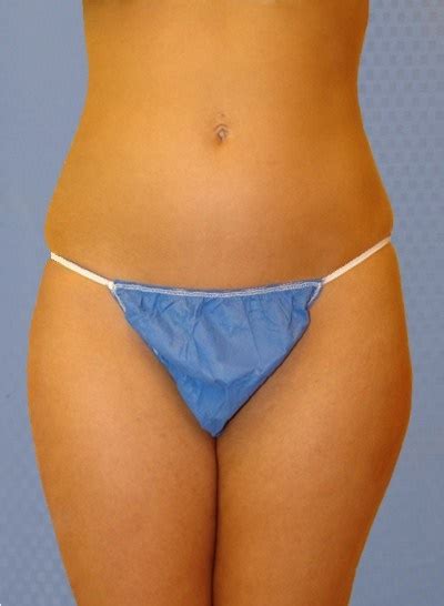 Check spelling or type a new query. Buttock Augmentation: - Dr. Maan Kattash - Cirugía ...