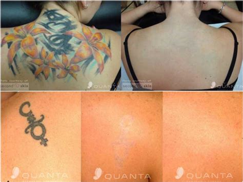 Laser tattoo removal is a new innovative way to remove unwanted body art. Gallery | Fresno, CA | California Vein & Laser