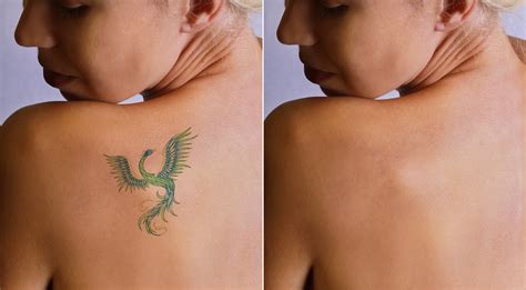 Before starting laser tattoo removal. Swimming Before and After Laser Tattoo Removal - InkAway ...