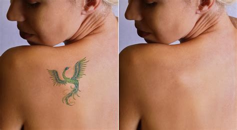 In general, however, it is best to wait at least 6 weeks between laser tattoo removal treatments. Swimming Before and After Laser Tattoo Removal - InkAway ...