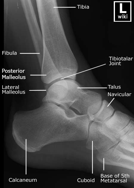 Posterior Malleolus Fractures - wikiRadiography