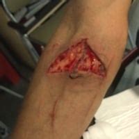 Trick of the Trade: V-to-Y flap laceration repair for tension wounds