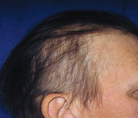 Hair loss in the primary stage syphilis occurs only when the chancre develop on the scalp. Alopecia | SpringerLink